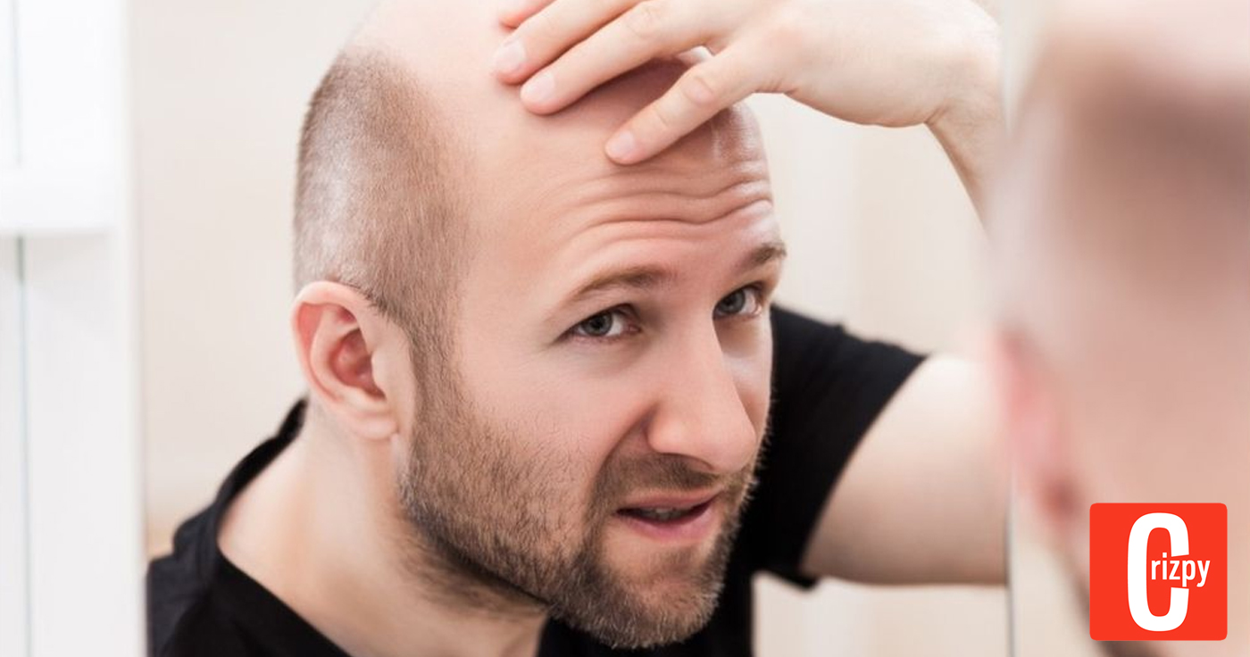 Zu viel Arbeit begünstigt Haarausfall bei Männern
