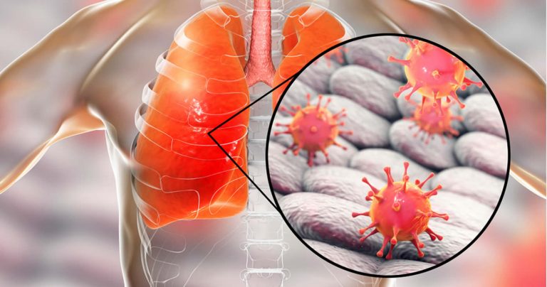 „Tödliche neue Lungenkrankheit“ – Update zu 2019-nCoV