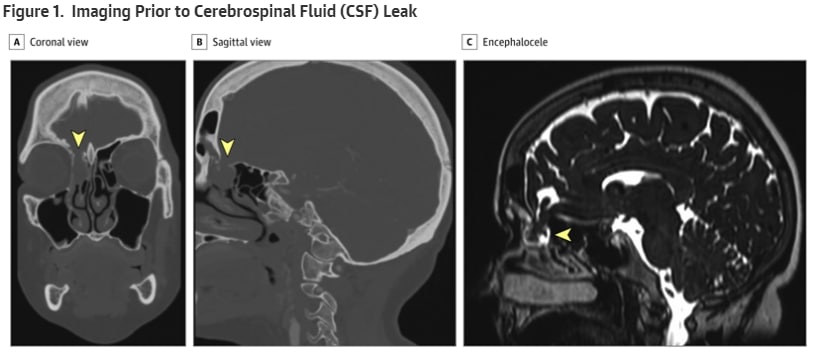 Screenshot: jamanetwork.com / A, Brain computed tomographic image from 2017 in the coronal and sagittal planes demonstrating encephalocele situated over the fovea ethmoidalis prior to nasopharyngeal testing for COVID-19. The arrowhead demonstrates skull base defect. B and C, High-resolution magnetic resonance imaging (T2 sequence) in the sagittal plane during hospital admission in July 2020 after development of iatrogenic CSF leak. The yellow arrowheads indicate the encephalocele.
