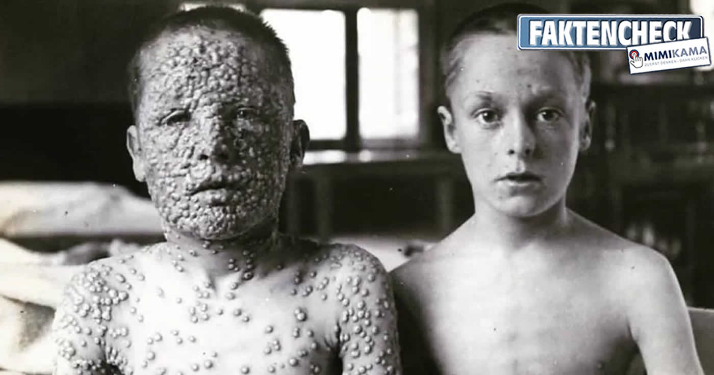 Pockenimpfung - Foto zweier Jungen, einer geimpft, der andere nicht (Faktencheck)