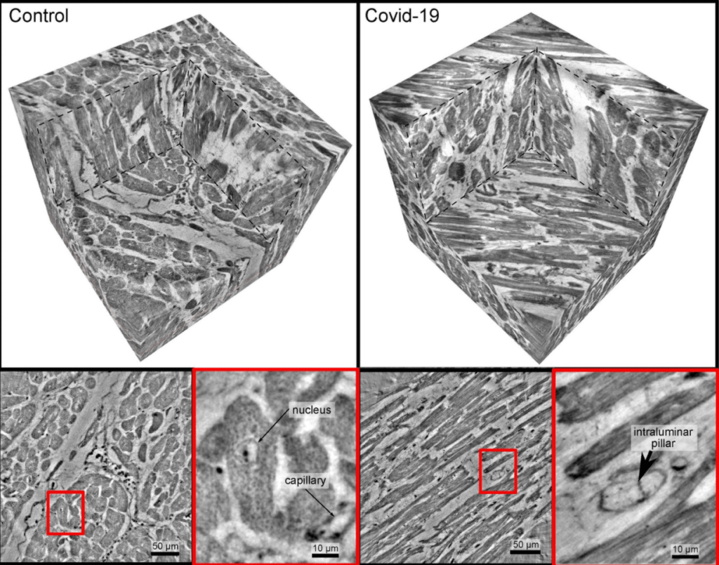 Herzgewebe im gesunden Zustand (links) und bei schwerem Verlauf von Covid-19 (rechts). Während die Gefäße im gesunden Fall eine intakte Struktur zeigen (rechts unten), erkennt man in den feinen Gefäßen (Kapillaren) bei der Covid-19-Gewebeprobe Einstülpungen und säulenartige Strukturen, die auf bestimme morphologische Umwandlungsprozesse der Gefäße hinweisen.   Foto: M. Reichardt, T. Salditt